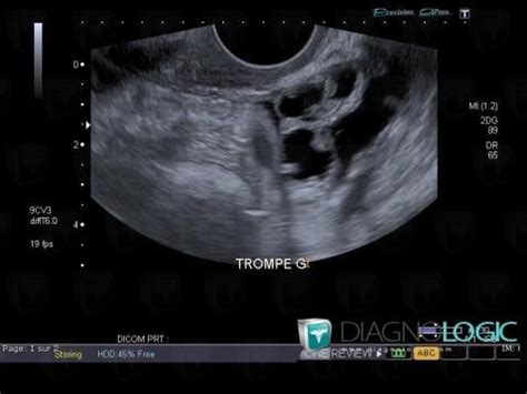 Radiology case : Hydrosalpinx (US) - Diagnologic