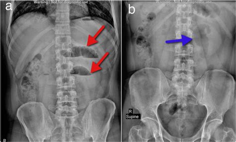 Plain Abdominal Radiographs A Multiple Air Fluid Levels Is Shown Red