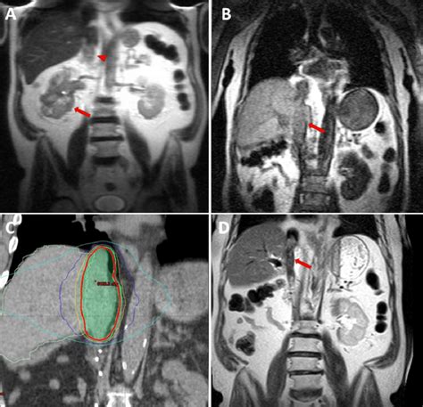 Mri Images Of A 74 Yo Man With Right Renal Mass Arrow And Tumor