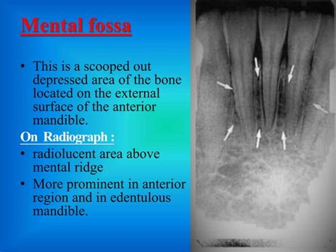 mandibular landmarks of radiograph