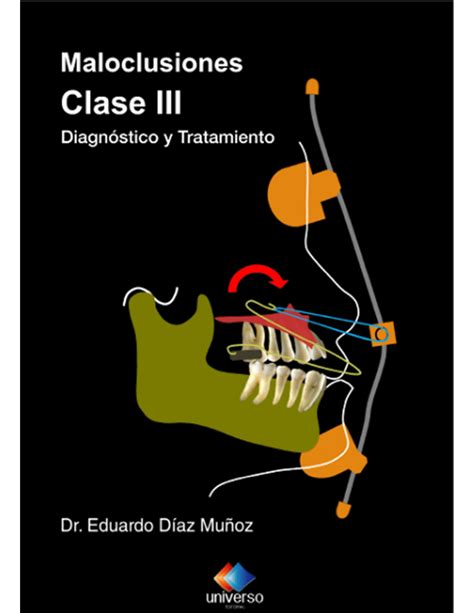 Pdf Maloclusión Clase Iii Diagnóstico Y Tratamiento