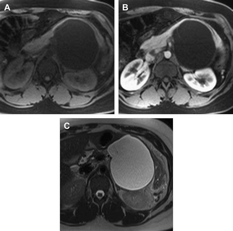 Mr Imaging Of The Pancreas Radiologic Clinics