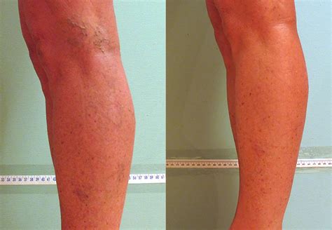 Spider Veins Before And After Photos Milwaukee Wi