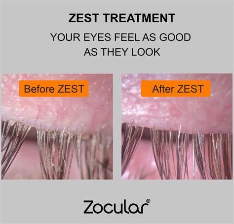 Zest Eyelid Cleansing System Eyespa Komoka London On