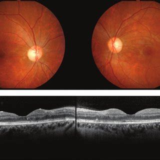 Initial Fundus Photography Fluorescein Angiography And Optical