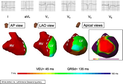 Ivcd intraventricular conduction delay - lopeztell