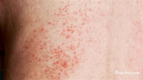 When Hepatitis C Shows Up on Your Skin: Understanding the Rash