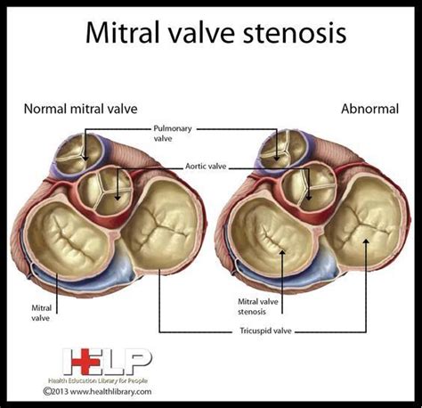 Mitral Valve Stenosis Mitral Valve Cardiac Nursing Medical School Essentials