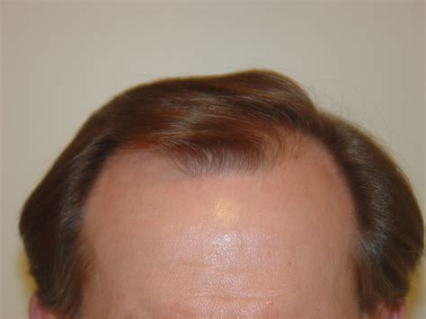 Before & After Photos - Dallas Hair Transplant - Armani Medical