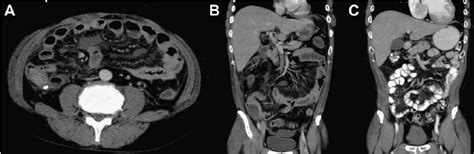 A Ct Of The Abdomen Showed Loculated Abscess Collection With Air