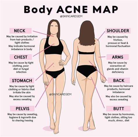 Skin Advice Skin Tips Skin Care Tips Body Acne Map Acne Treatment