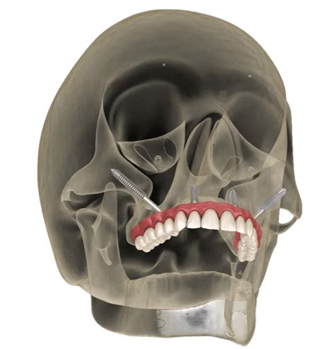 Zygomatic Arch Implants