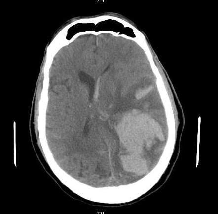 Subfalcine herniation | Radiology Case | Radiopaedia.org