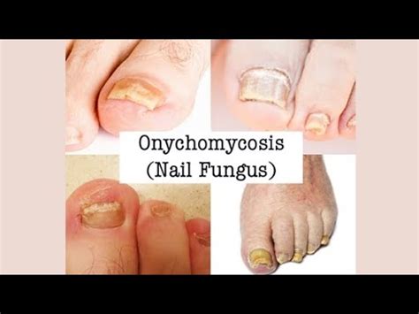 ONYCHOMYCOSIS: symptoms, treatment and prevention. - YouTube