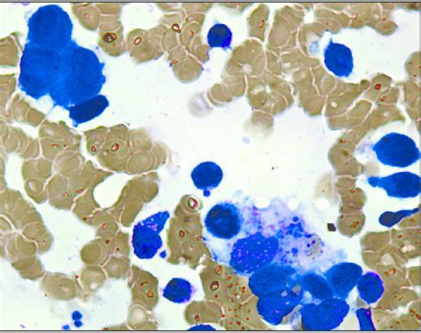 Bone Marrow Smear Showing Hemophagocytosis And Lymphoma Cell