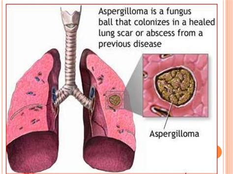 Fungal Diseases Of Lung