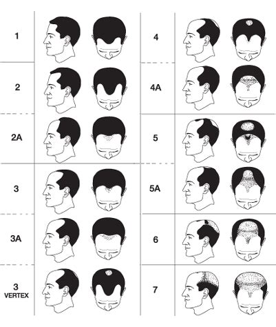 Norwood Classification Understanding Male Pattern Baldness