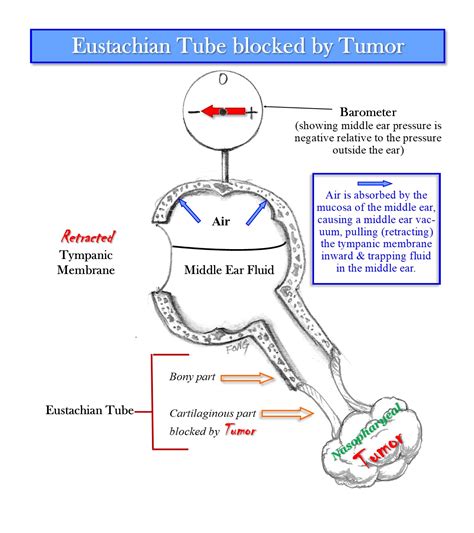 Eustachian Tube Blockage, Otitis Media and Nasopharynx Tumors