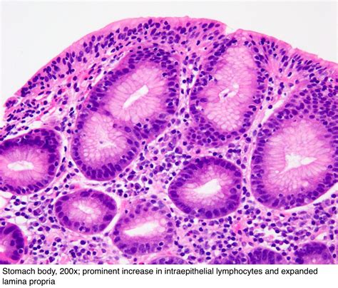 Pathology Outlines Lymphocytic Gastritis