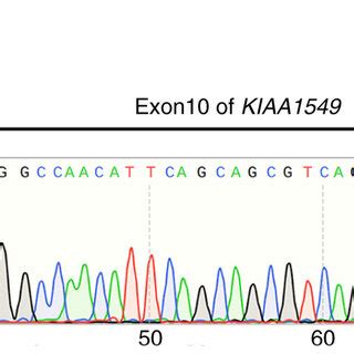 KIAA1549 BRAF Fusion Protein A RT PCR Of KIAA1549 BRAF Fusion