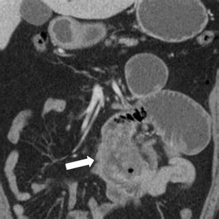 A 47 Year Old Man Presenting With Nausea Vomiting And Epigastric Pain