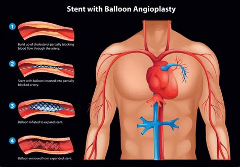 Stents Types Procedure And Benefits Add More To Life Meril