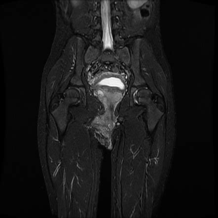 Plexiform Neurofibroma Of Perineum And Pelvis Radiology Case