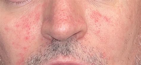 Red Marks Around Nose And Cheeks Rosacea Or Something Else Rdermatologyquestions