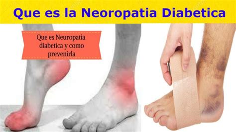 NEUROPATIA DIABETICA TIPOS DE NEUROPATIA VIDA CON SALUD