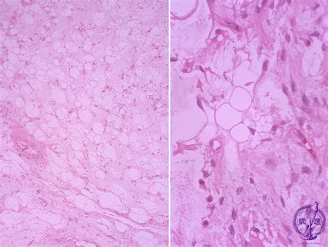 18 Soft Tissue 1 Lipoma Liposarcoma Myxoid Liposarcoma Pathology