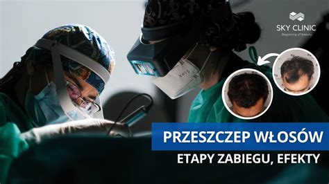 Na czym polega przeszczep włosów Najskuteczniejsze metody YouTube