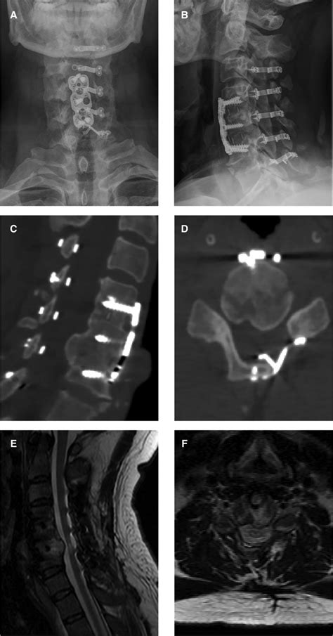 Osteophyte Formation Lumbar Spine