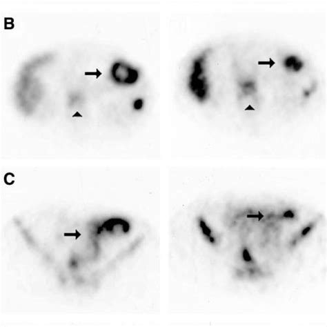 99m Tc Hmpao Wbc Whole Body Scintigraphy Patient 14 In Anterior Ant