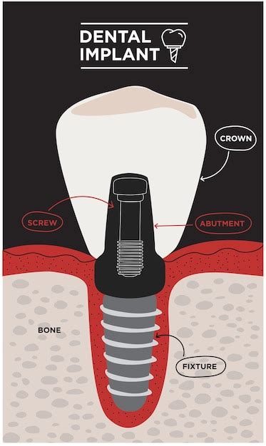 Tand Anatomie Vector Tandheelkundige Infographics Medische Spandoek Of