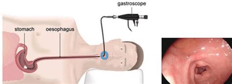 Gastroscopy Procedure And A Typical Image Download Scientific Diagram