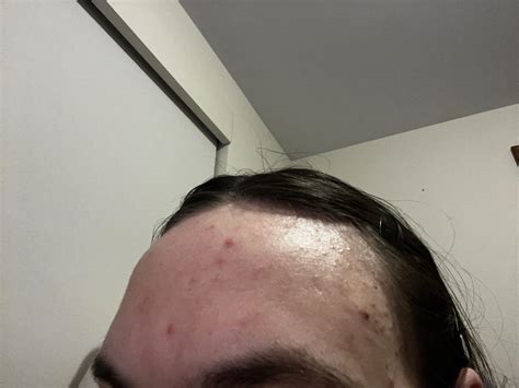 What Can I Do In My Skin Routine To Help These Spots And Bumps On My Forehead I’ve Never Had