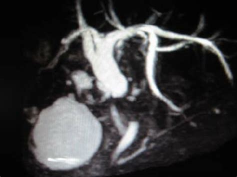 Erc Image Of Mid Common Bile Duct Stricture Download Scientific Diagram