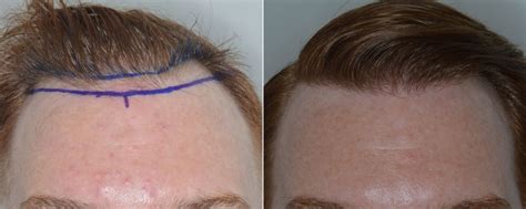 Hair Transplant Photos Miami Fl Patient 3468