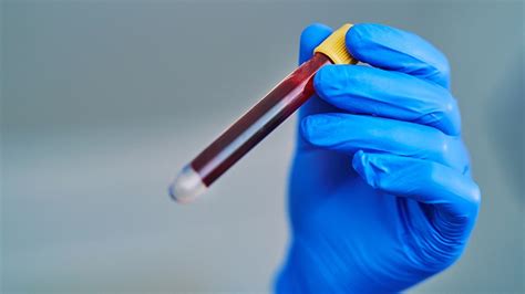 Blood Test Shows Promise For Predicting Treatment Response In