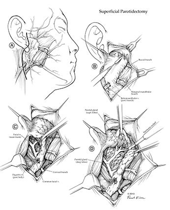 Superficial Parotidectomy by Paul Kim Paul Kim, Medical Illustration ...