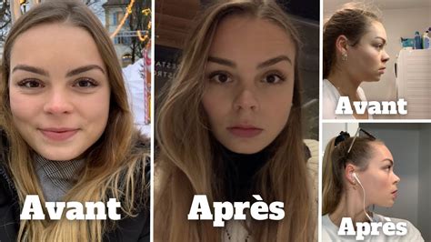 Mincir Du Visage En Seulement Quelques Heures Sans Perte De Poids