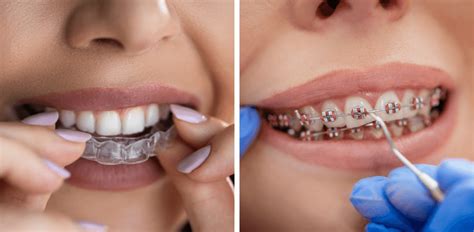 Clear Aligners Vs Braces Choosing The Best Orthodontic Treatment