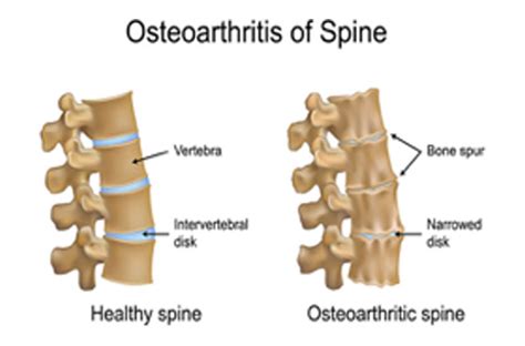 Degenerative Joint Diseases