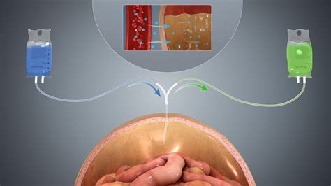 Side effects of kidney dialysis | General center | SteadyHealth.com