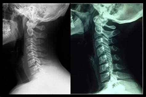 Rectificaci N Cervical Enrique Garc A Ballesteros