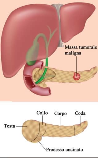 Secondo Lateralmente Impastare Tumore Pancreas Iv Stadio Partenza