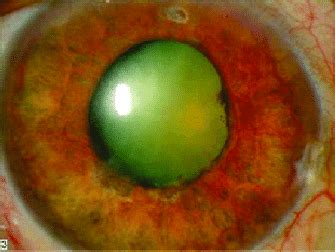 Neovascularisation of iris. | Download Scientific Diagram