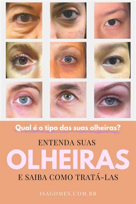 Descubra qual é o tipo das suas olheiras e saiba como tratá las