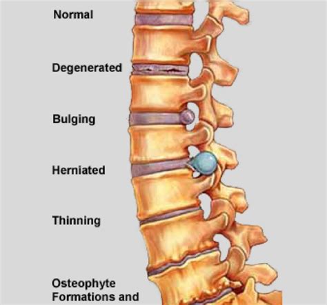 Emg Best Test For Cervical Radiculopathy Pinched Nerves Neuro