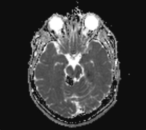 Quadrigeminal Cistern Lipoma Image